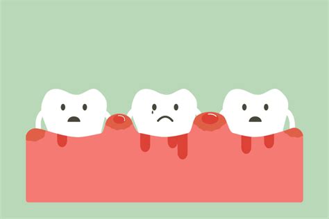 Gamot Sa Namamagang Gums: What's the Best .